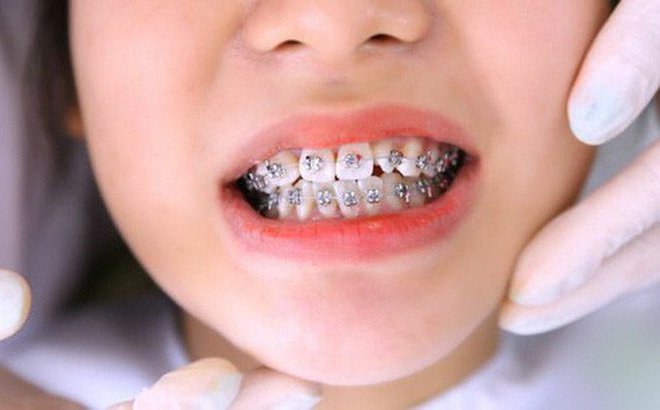 Giá cả niềng răng chịu tác động bởi yếu tố nào?