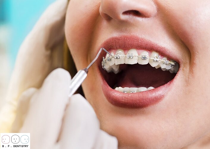 Khi bọc răng sứ có niềng răng được không?