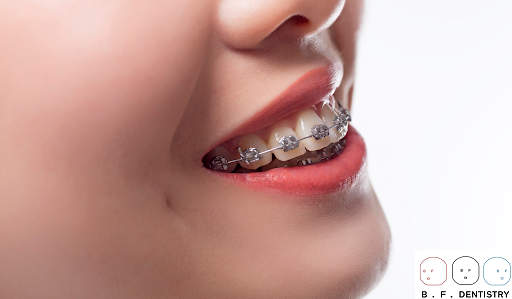 Cách điều trị răng hô phổ biến?