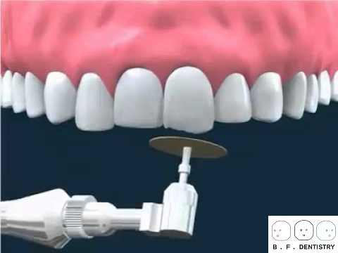 Cách điều trị răng cửa to và dài?