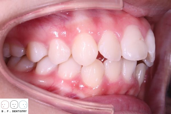 Có nên sửa răng vẩu?