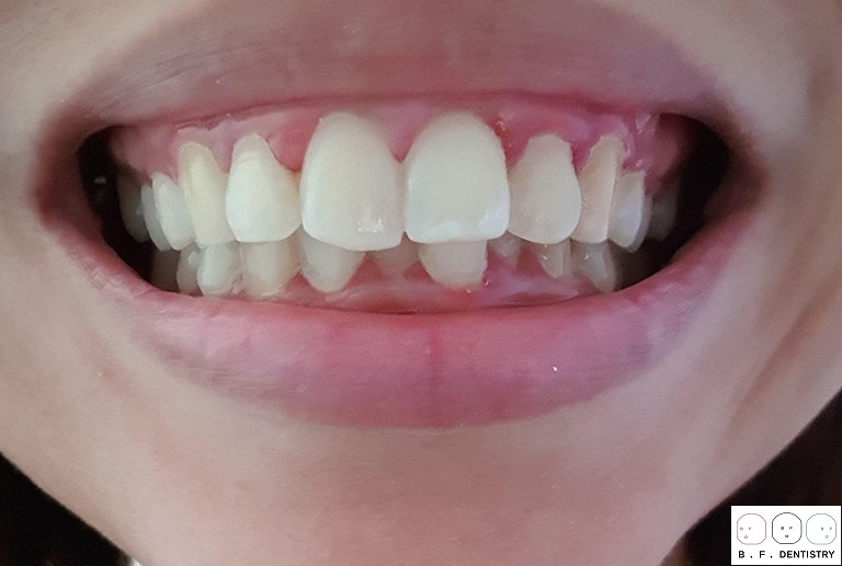 Có nên dán răng sứ cho 2 răng cửa bị vẩu?