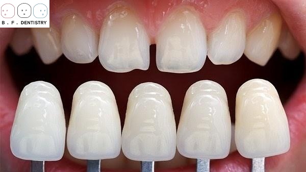 Cách làm răng không bị thưa bằng dán răng sứ liệu có ổn?