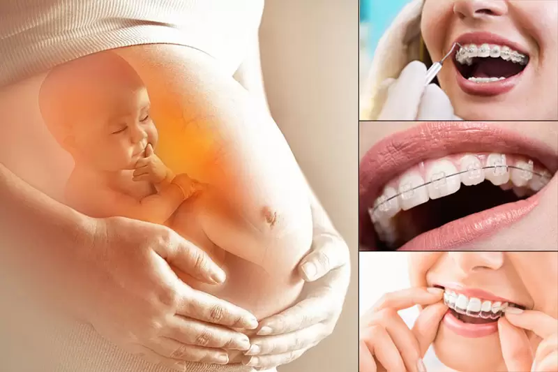 Mang thai có niềng răng được không?